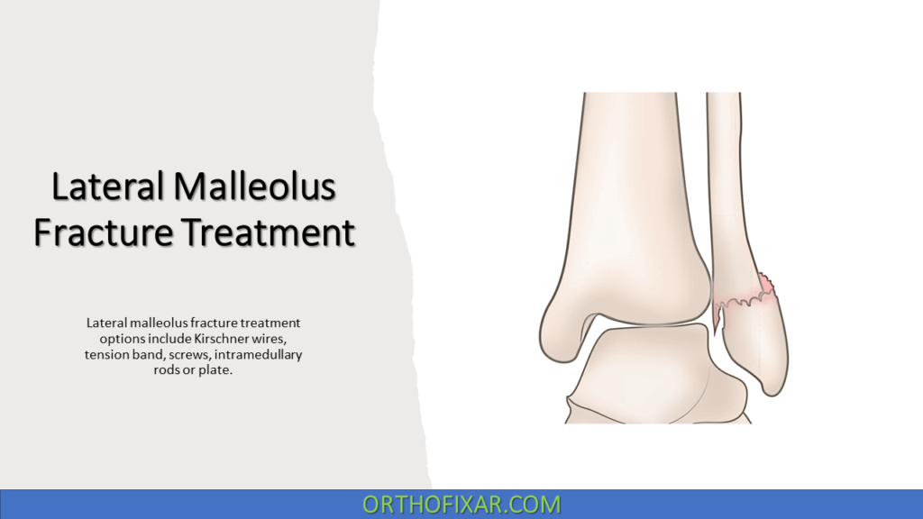 Maleulus Lateral Malleolus Fracture Treatment: Surgical Options And Fixation