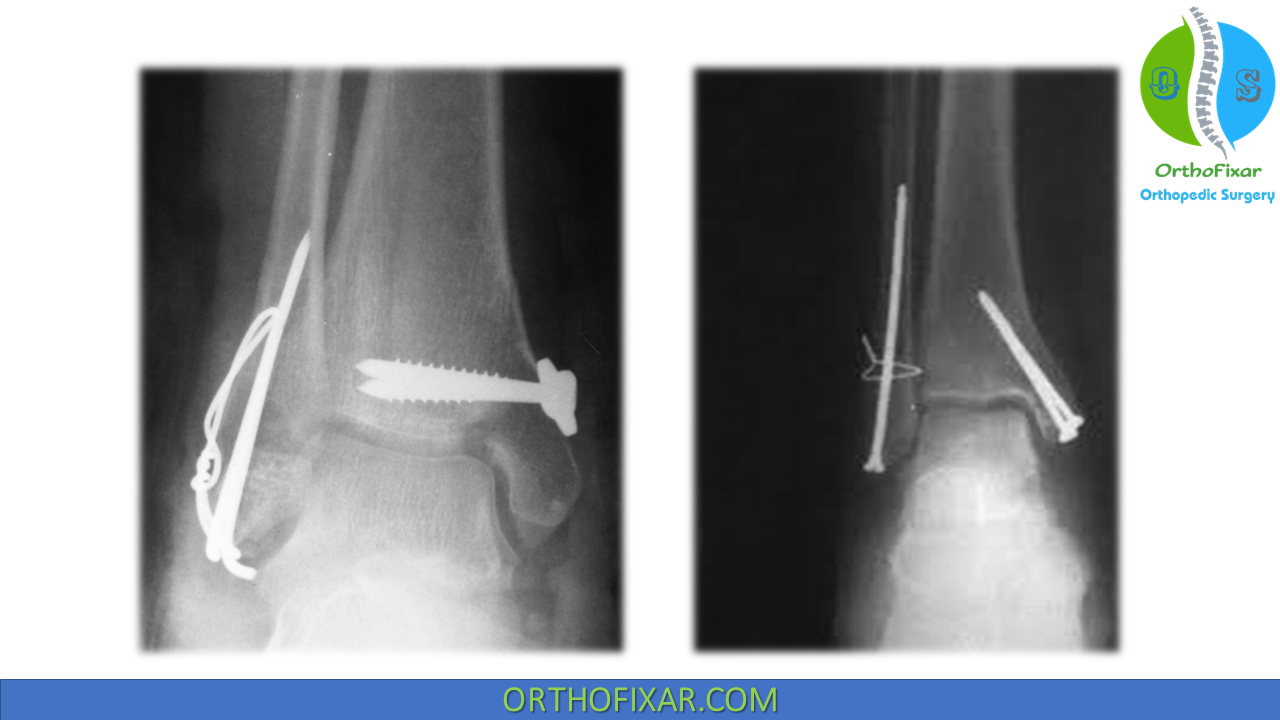 Lateral Malleolus Fracture Treatment