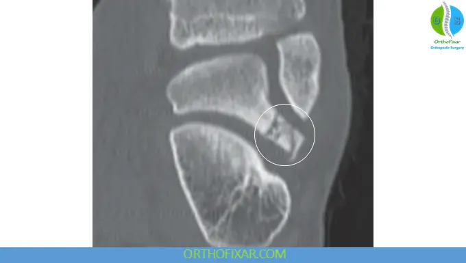 Lateral Process Talar Fractures