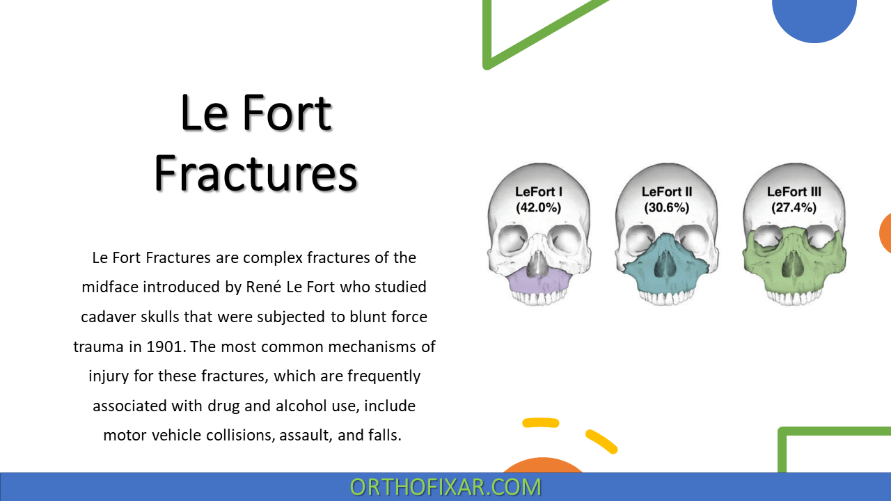 Le Fort Fractures 
