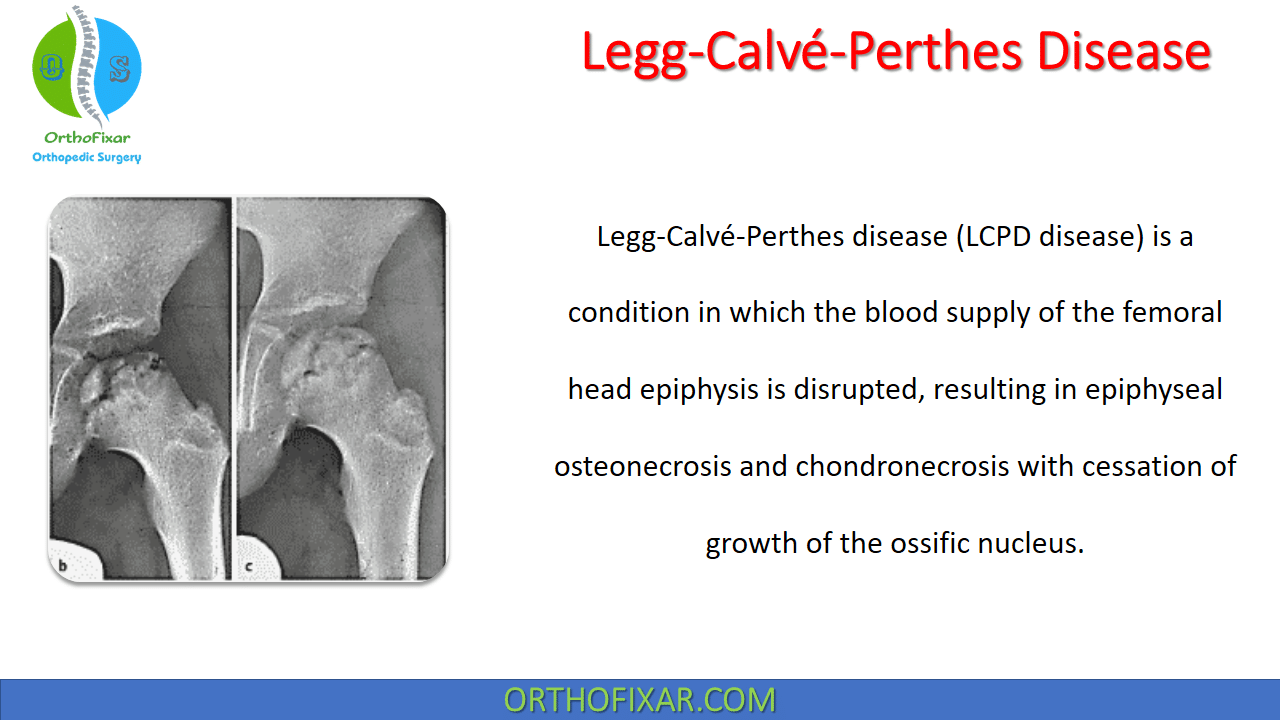 slipped capital femoral epiphysis vs legg calve perthes disease