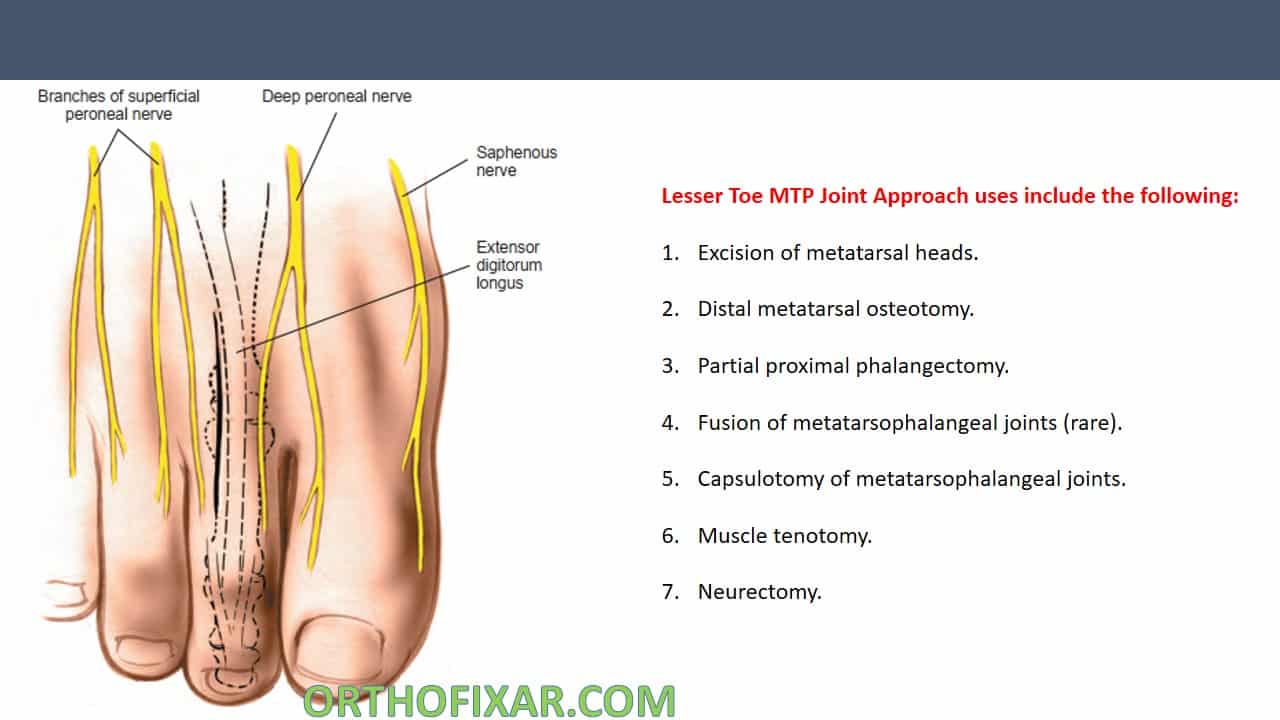  Lesser Toe MTP Joint Approach 