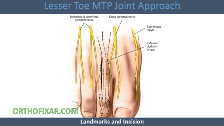 Lesser Toe Joint Injection Lesser Toe MTP Joint Approach: Surgical Technique, Indications, And ...