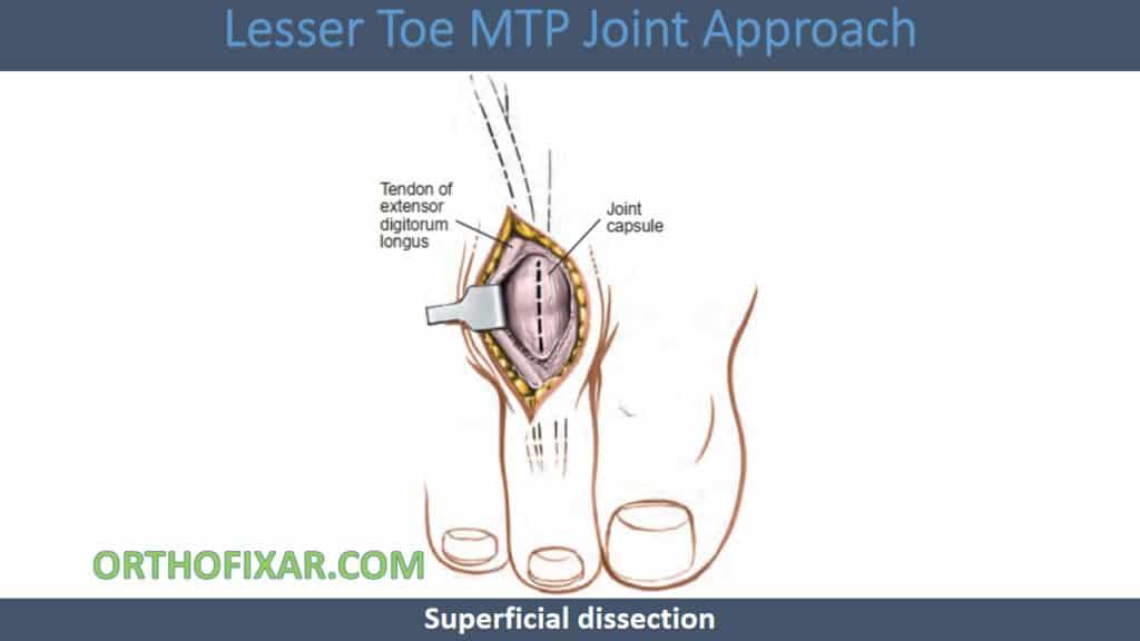 Lesser Toe MTP Joint Approach
