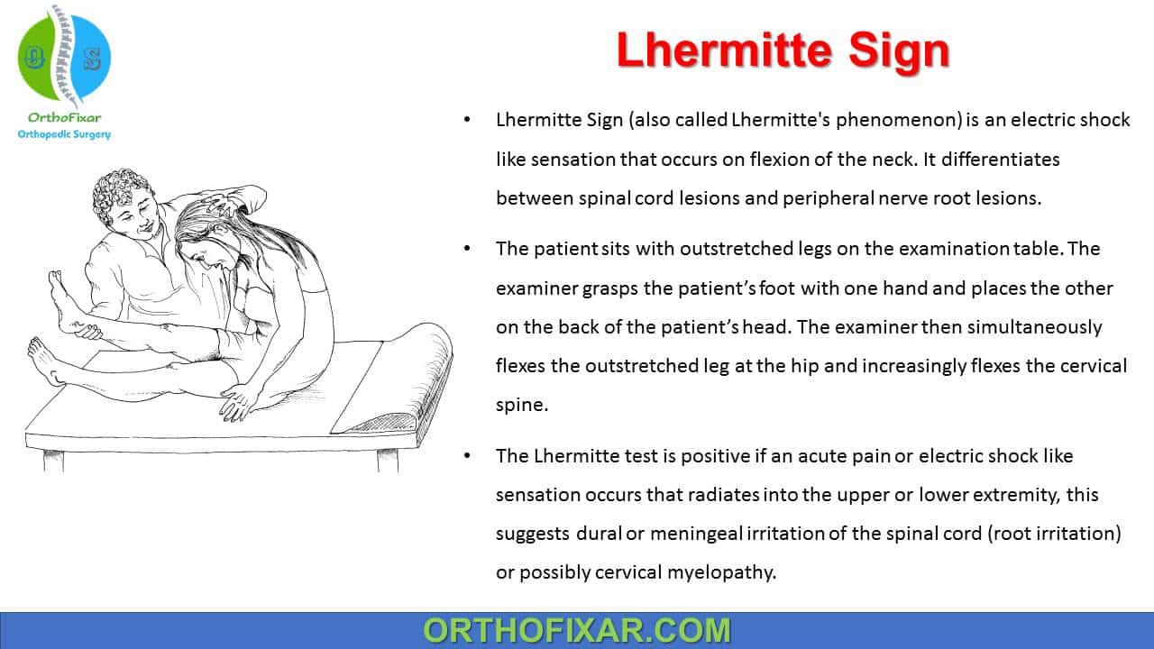  Lhermitte Sign 