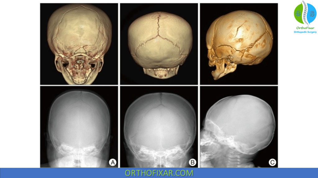 Linear skull fractures