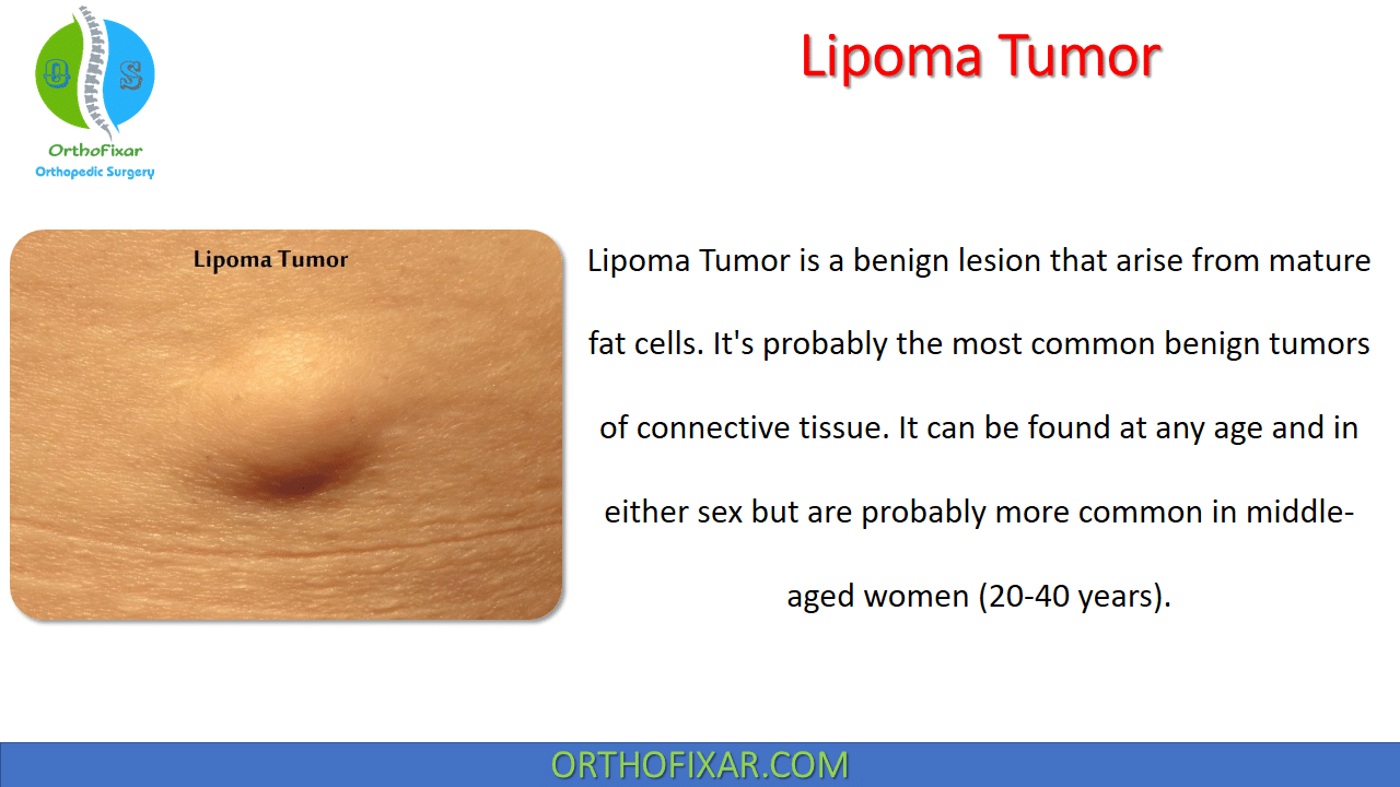 Tumor Lipoma Apa Itu - Infoupdate.org