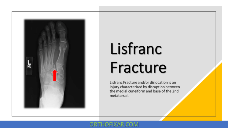Lisfranc Fracture