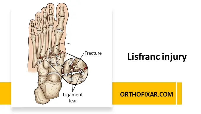 Lisfranc injury