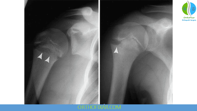 Little Leaguers Shoulder