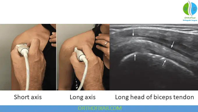 Long Head of Biceps ultrasound