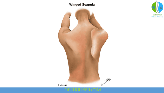 Long Thoracic Nerve Scapular Winging