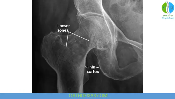 Looser zones