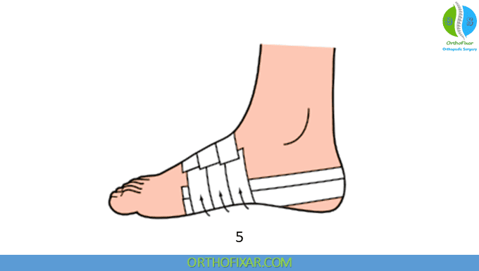 Low Dye Taping 3 Low Dye Taping 3