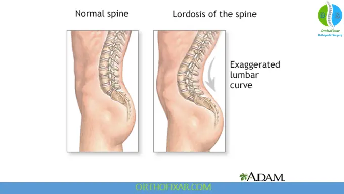 Lumbar Lordosis