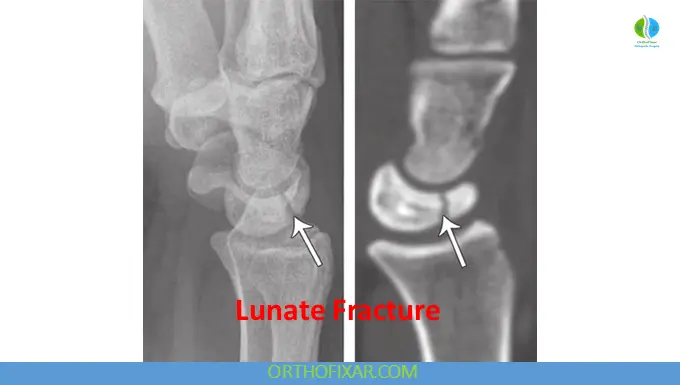 Lunate Fractures xray