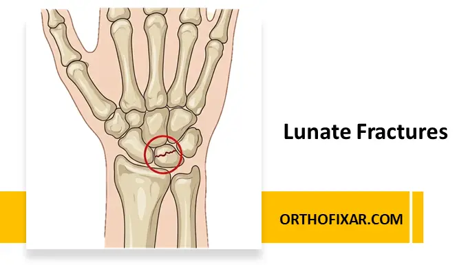 Lunate Fractures