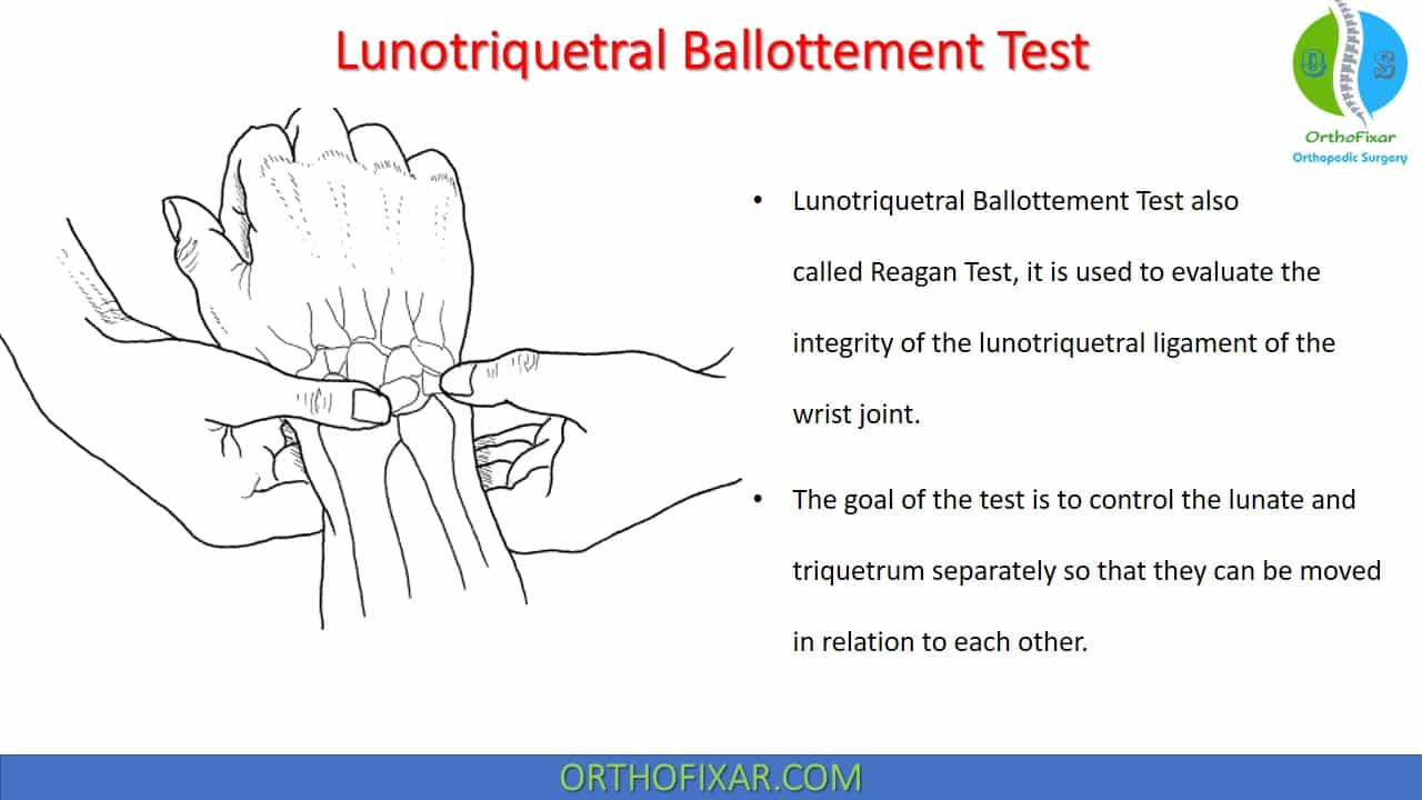  Lunotriquetral Ballottement Test 