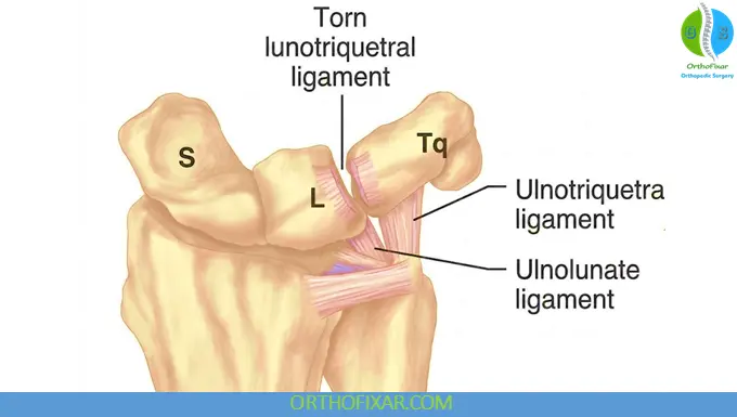 Lunotriquetral Dissociation diagram