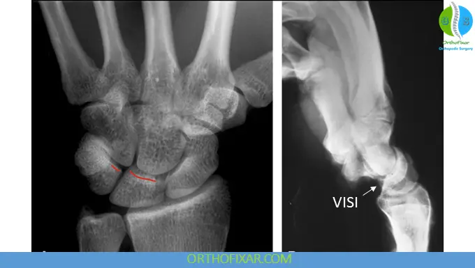 Lunotriquetral Dissociation imaging xray