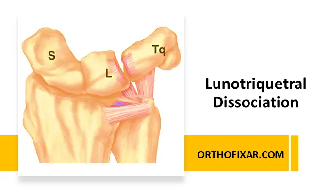 Lunotriquetral Dissociation