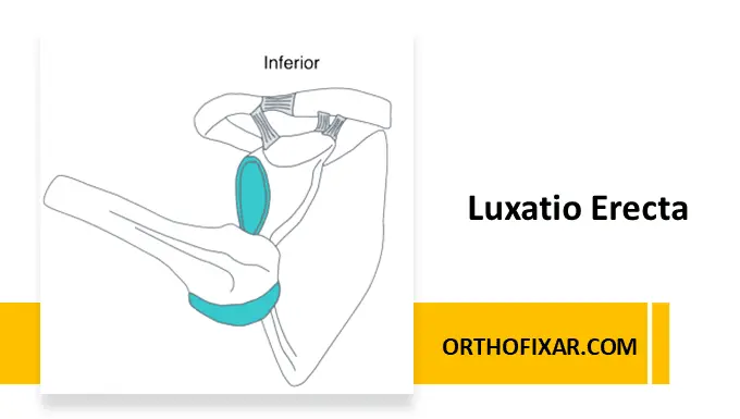Luxatio Erecta (Inferior Glenohumeral Dislocation)