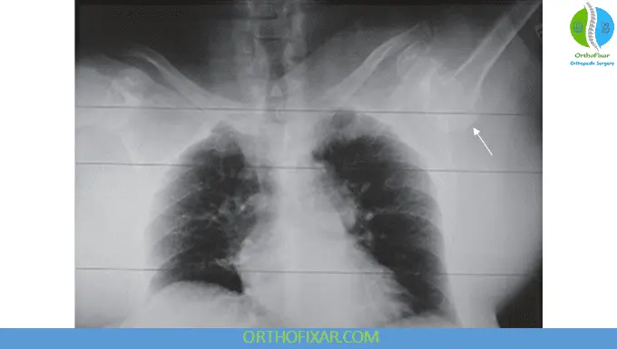 Luxatio Erecta (Inferior Shoulder Dislocation) 4 Luxatio Erecta xray