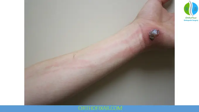 Lymphangitis Symptoms