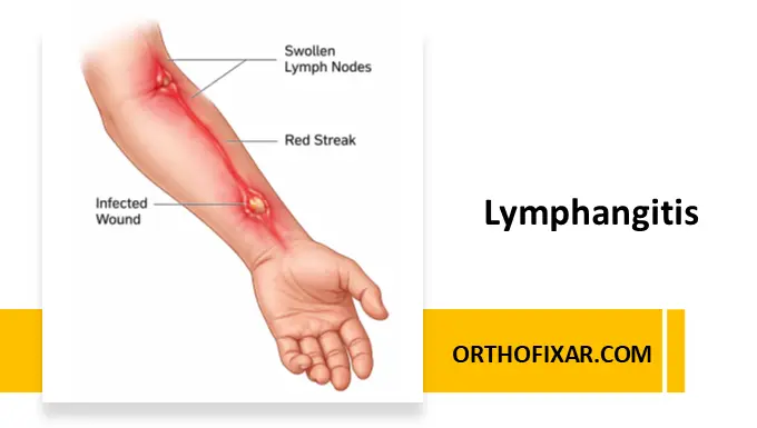 Lymphangitis