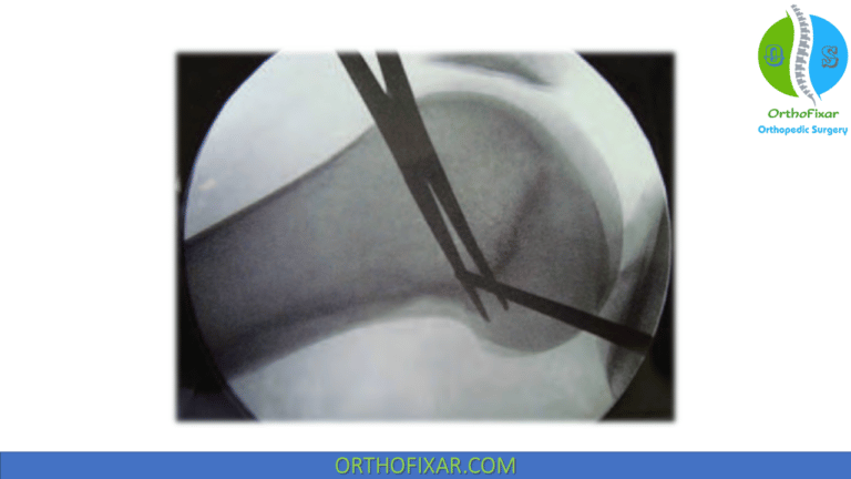 MPFL Reconstruction Surgery | OrthoFixar 2025