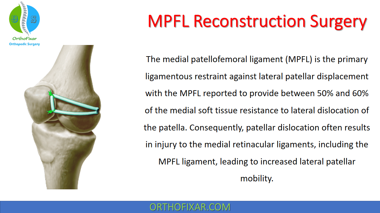 Medial Patellofemoral Ligament