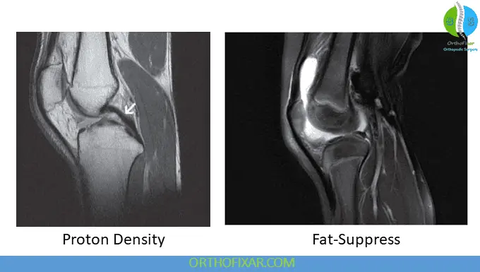 MRI Fat-Suppressed Sequences & Proton Density Imaging
