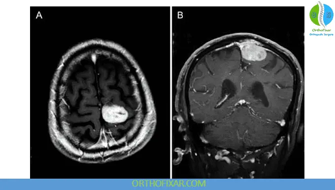 MRI Gadolinium Contrast in MRI