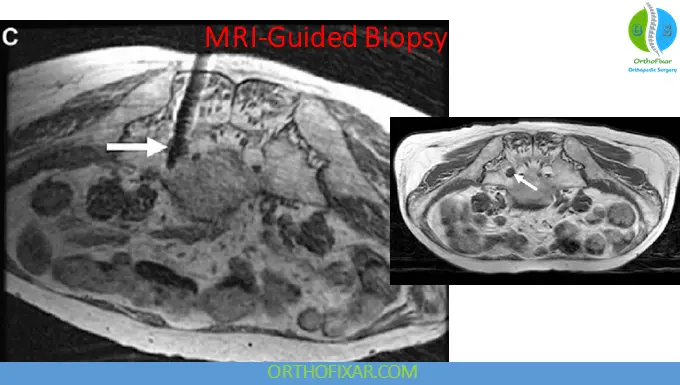 Bone Biopsy: Indications, Types, Risks & Diagnostic Accuracy 5 MRI-Guided Bone Biopsy