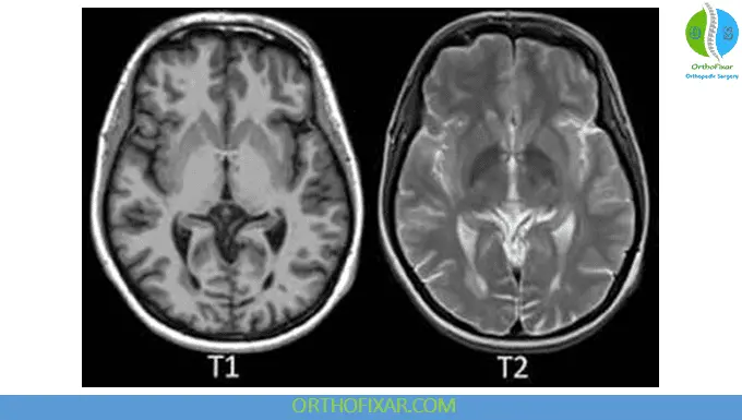 MRI Scan T1 & T2