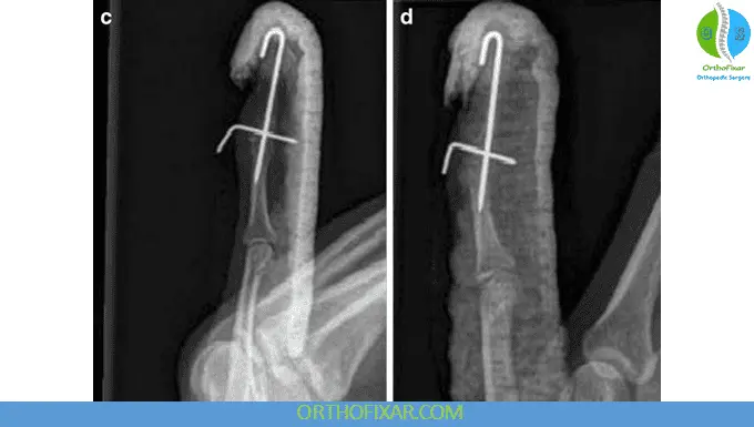 Mallet Finger treatment