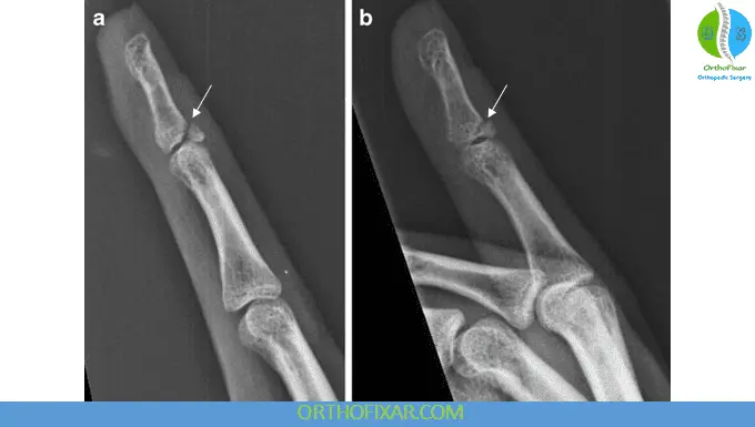Mallet Finger xray