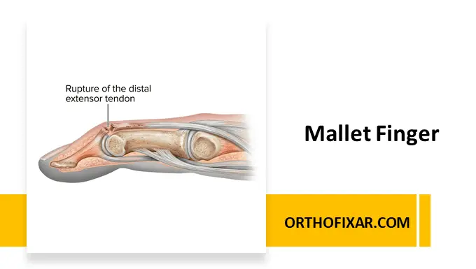 Mallet Finger