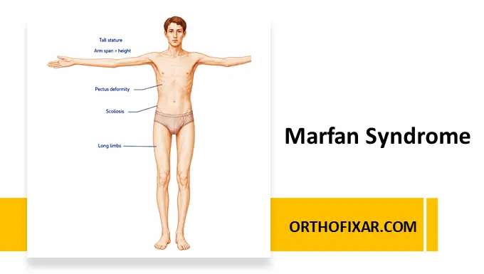Marfan Syndrome