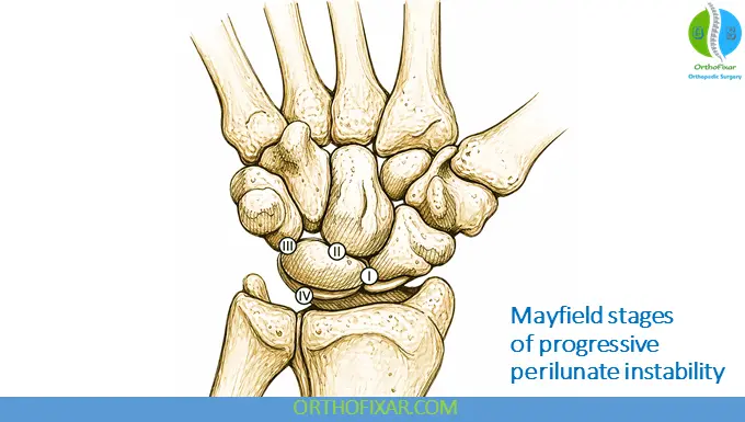 Mayfield stages of progressive perilunate instability