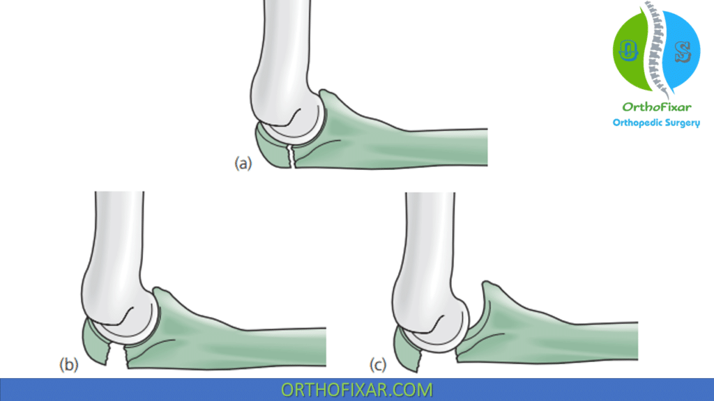 Mayo classification of fractures of the olecranon