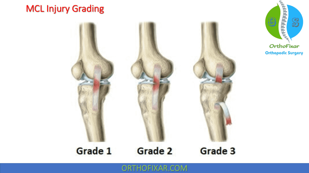 Mcl injury grading