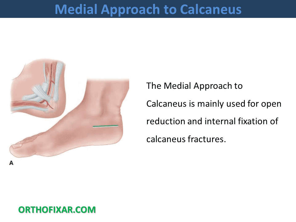  Medial Approach to Calcaneus 