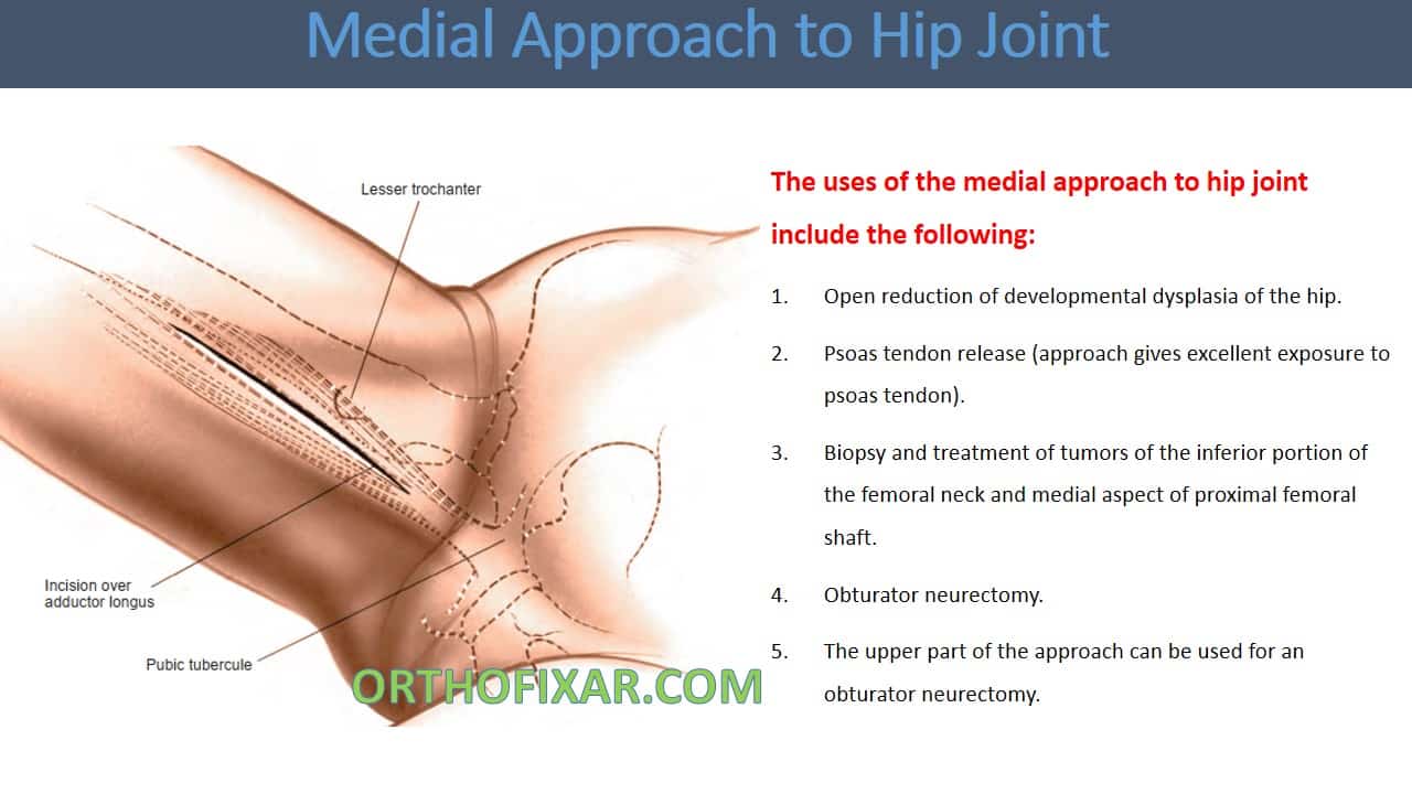  Medial Approach to Hip Joint 