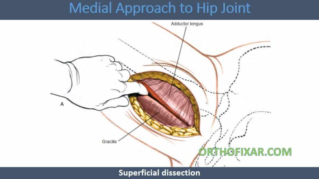 Medial Approach to Hip Joint