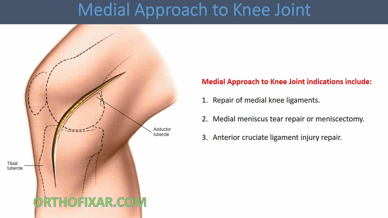  Medial Approach to Knee Joint 