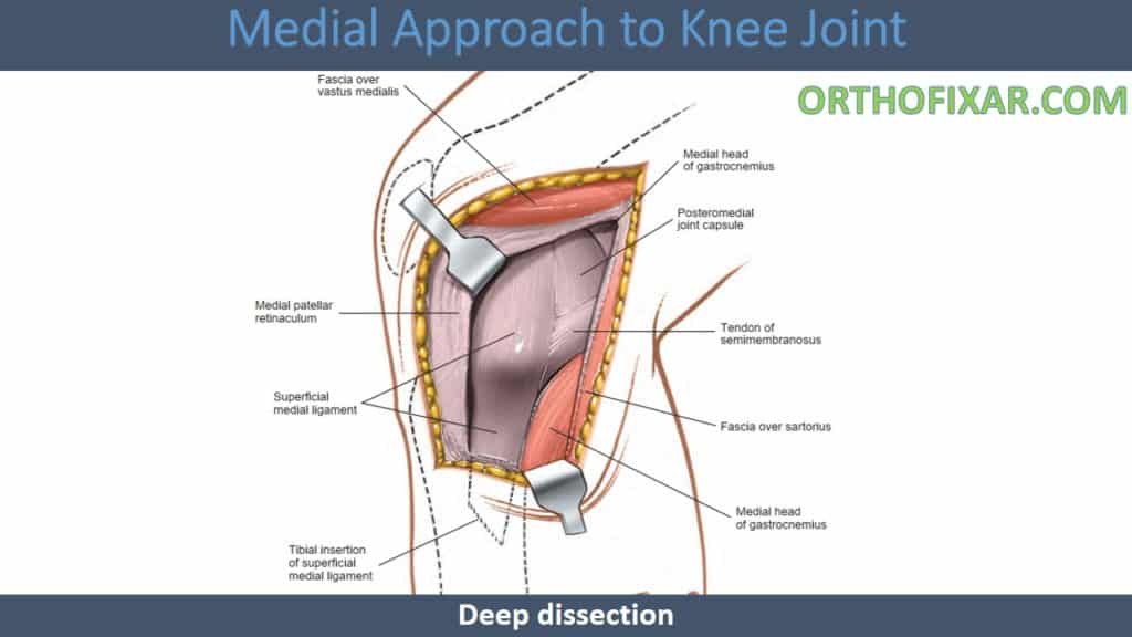 Medial Approach to Knee Joint