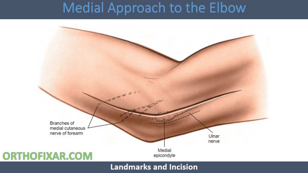 Medial Approach to the Elbow