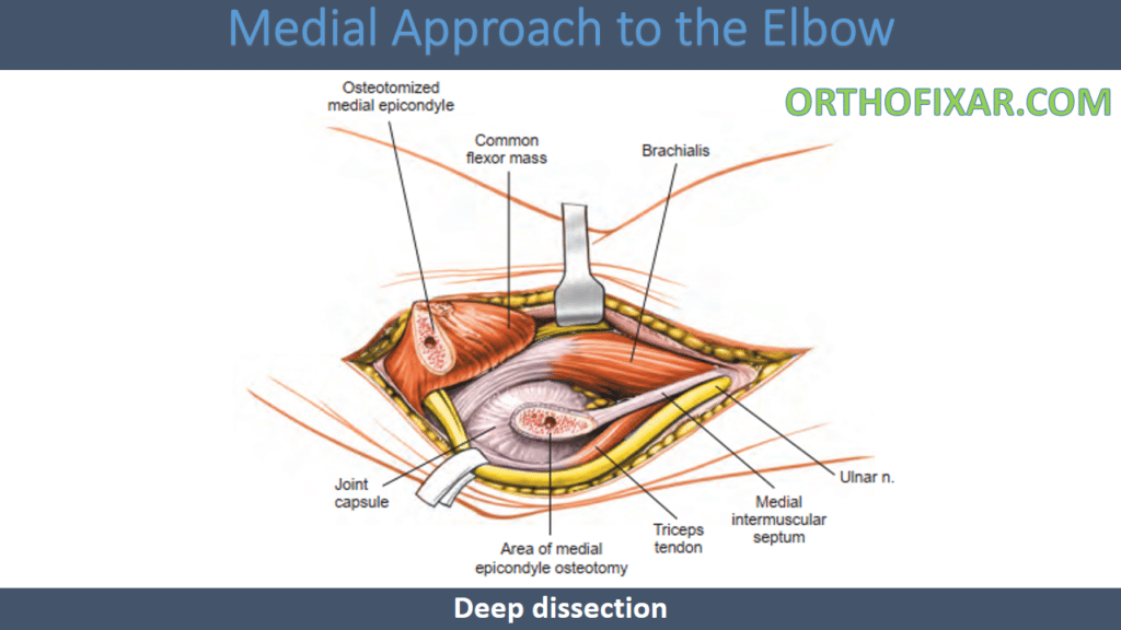 Medial Approach to the Elbow