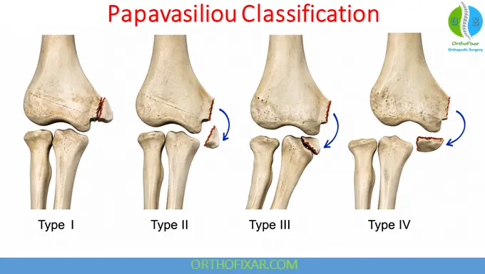Medial Epicondyle Fracture Papavasiliou Classification